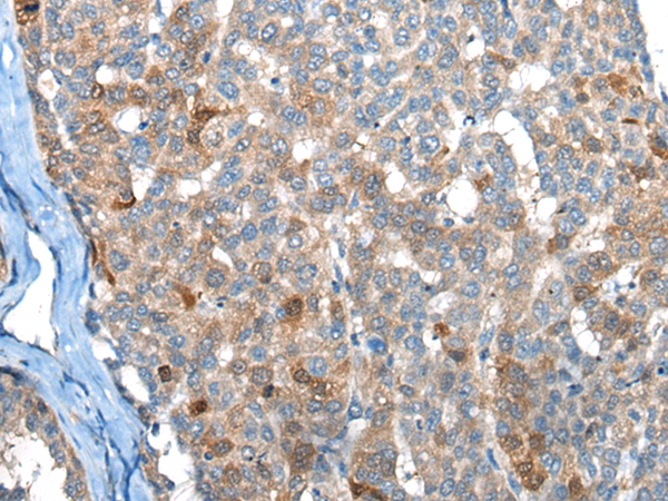 Immunohistochemistry of paraffin-embedded Human liver cancer tissue  using BHMT2 Polyclonal Antibody at dilution of 1:45(×200)