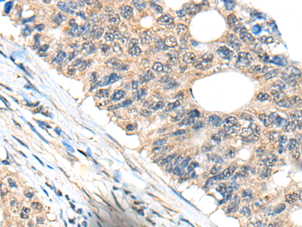 Immunohistochemistry of paraffin-embedded Human colorectal cancer tissue  using BHMT2 Polyclonal Antibody at dilution of 1:45(×200)