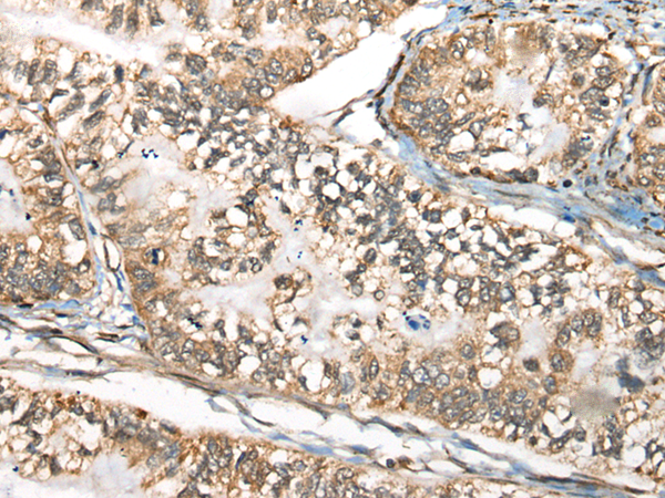 Immunohistochemistry of paraffin-embedded Human gastric cancer tissue  using BLNK Polyclonal Antibody at dilution of 1:65(×200)