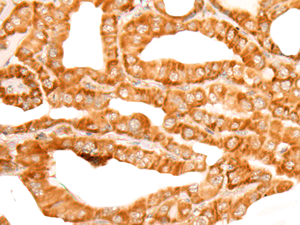 Immunohistochemistry of paraffin-embedded Human thyroid cancer tissue  using ZMYND10 Polyclonal Antibody at dilution of 1:35(×200)