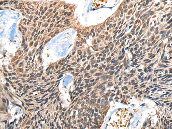 Immunohistochemistry of paraffin-embedded Human esophagus cancer tissue  using BOLA1 Polyclonal Antibody at dilution of 1:50(×200)