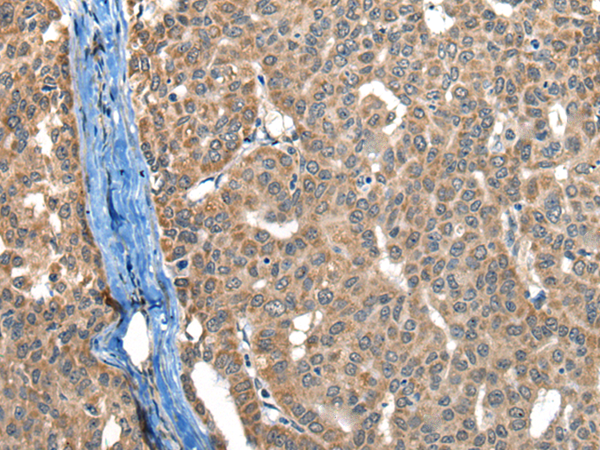 Immunohistochemistry of paraffin-embedded Human liver cancer tissue  using BOLA1 Polyclonal Antibody at dilution of 1:50(×200)