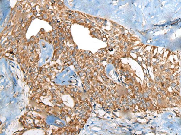 Immunohistochemistry of paraffin-embedded Human thyroid cancer tissue  using BRD9 Polyclonal Antibody at dilution of 1:80(×200)