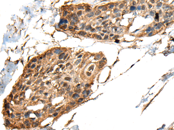 Immunohistochemistry of paraffin-embedded Human esophagus cancer tissue  using MCPH1 Polyclonal Antibody at dilution of 1:40(×200)