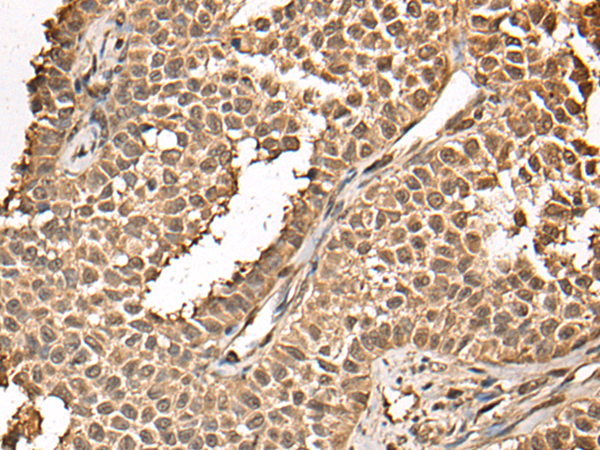 Immunohistochemistry of paraffin-embedded Human ovarian cancer tissue  using BUD31 Polyclonal Antibody at dilution of 1:45(×200)