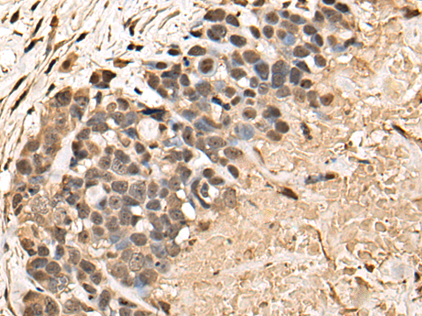 Immunohistochemistry of paraffin-embedded Human thyroid cancer tissue  using BUD31 Polyclonal Antibody at dilution of 1:45(×200)