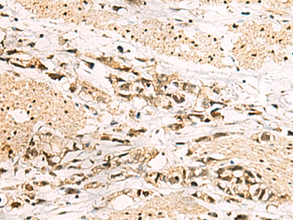 Immunohistochemistry of paraffin-embedded Human gastric cancer tissue  using LRIF1 Polyclonal Antibody at dilution of 1:70(×200)