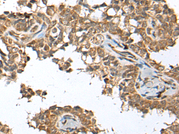 Immunohistochemistry of paraffin-embedded Human ovarian cancer tissue  using SPRTN Polyclonal Antibody at dilution of 1:65(×200)