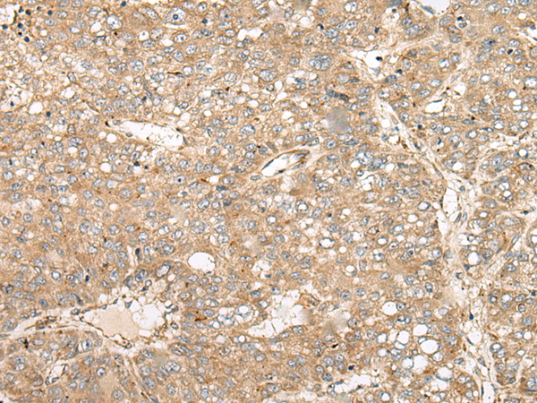 Immunohistochemistry of paraffin-embedded Human liver cancer tissue  using COA7 Polyclonal Antibody at dilution of 1:55(×200)