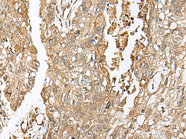 Immunohistochemistry of paraffin-embedded Human lung cancer tissue  using COA7 Polyclonal Antibody at dilution of 1:55(×200)