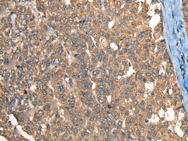Immunohistochemistry of paraffin-embedded Human liver cancer tissue  using C1R Polyclonal Antibody at dilution of 1:40(×200)