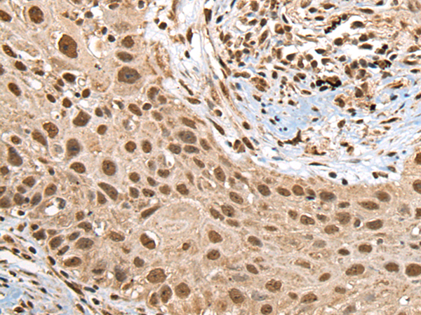 Immunohistochemistry of paraffin-embedded Human lung cancer tissue  using RTCB Polyclonal Antibody at dilution of 1:45(×200)