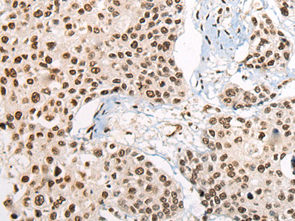 Immunohistochemistry of paraffin-embedded Human prost ate cancer tissue  using RTCB Polyclonal Antibody at dilution of 1:45(×200)