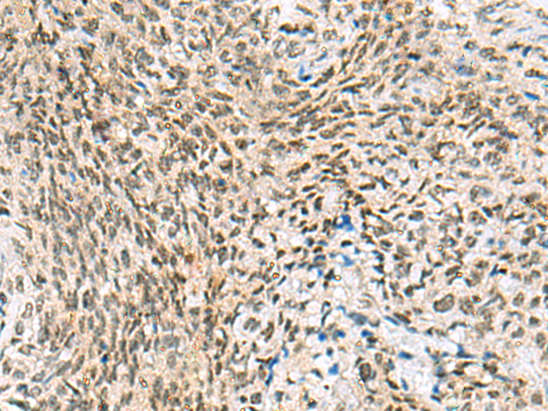 Immunohistochemistry of paraffin-embedded Human cervical cancer tissue  using C3orf38 Polyclonal Antibody at dilution of 1:95(×200)