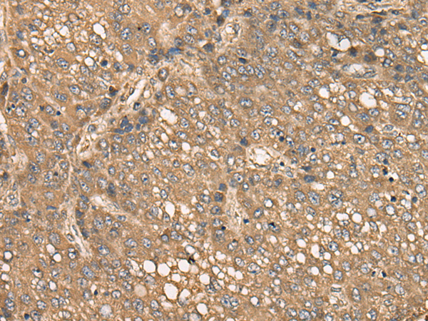 Immunohistochemistry of paraffin-embedded Human liver cancer tissue  using C4BPB Polyclonal Antibody at dilution of 1:35(×200)