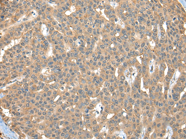 Immunohistochemistry of paraffin-embedded Human liver cancer tissue  using CA7 Polyclonal Antibody at dilution of 1:40(×200)