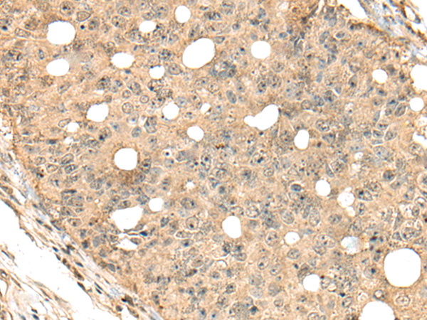 Immunohistochemistry of paraffin-embedded Human colorectal cancer tissue  using CA7 Polyclonal Antibody at dilution of 1:40(×200)