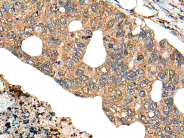 Immunohistochemistry of paraffin-embedded Human colorectal cancer tissue  using PPP3R1 Polyclonal Antibody at dilution of 1:80(×200)