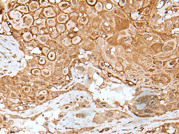 Immunohistochemistry of paraffin-embedded Human esophagus cancer tissue  using IL6ST Polyclonal Antibody at dilution of 1:40(×200)