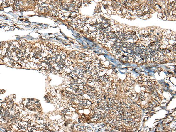 Immunohistochemistry of paraffin-embedded Human gastric cancer tissue  using CALHM1 Polyclonal Antibody at dilution of 1:40(×200)