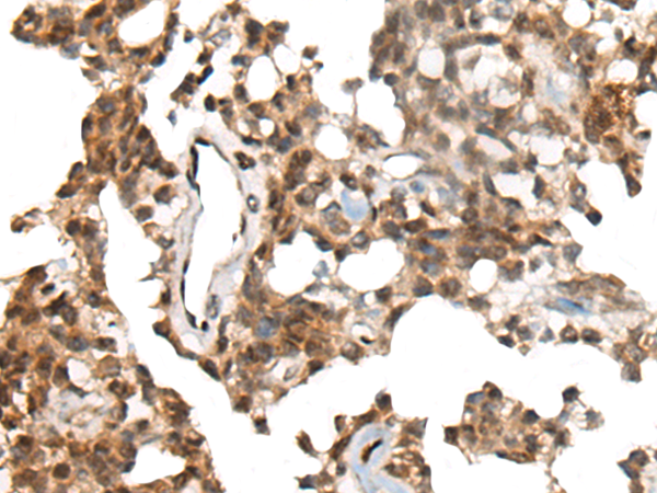 Immunohistochemistry of paraffin-embedded Human ovarian cancer tissue  using CALML5 Polyclonal Antibody at dilution of 1:90(×200)