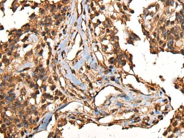 Immunohistochemistry of paraffin-embedded Human ovarian cancer tissue  using CAMKK1 Polyclonal Antibody at dilution of 1:35(×200)