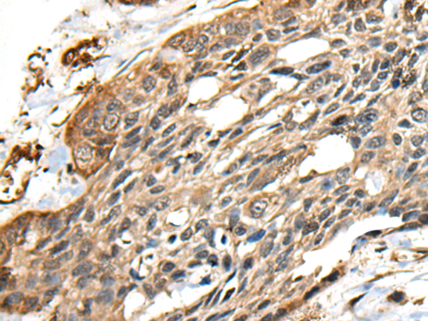 Immunohistochemistry of paraffin-embedded Human esophagus cancer tissue  using CCDC113 Polyclonal Antibody at dilution of 1:35(×200)