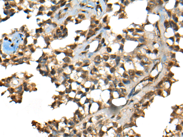 Immunohistochemistry of paraffin-embedded Human ovarian cancer tissue  using CCDC12 Polyclonal Antibody at dilution of 1:50(×200)