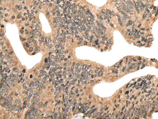 Immunohistochemistry of paraffin-embedded Human colorectal cancer tissue  using CCNB1IP1 Polyclonal Antibody at dilution of 1:30(×200)