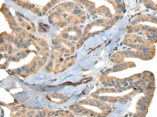 Immunohistochemistry of paraffin-embedded Human thyroid cancer tissue  using CDADC1 Polyclonal Antibody at dilution of 1:40(×200)