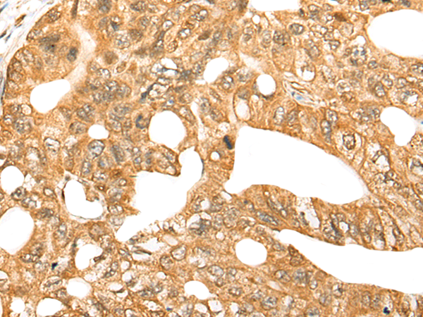 Immunohistochemistry of paraffin-embedded Human gastric cancer tissue  using CDCA4 Polyclonal Antibody at dilution of 1:70(×200)