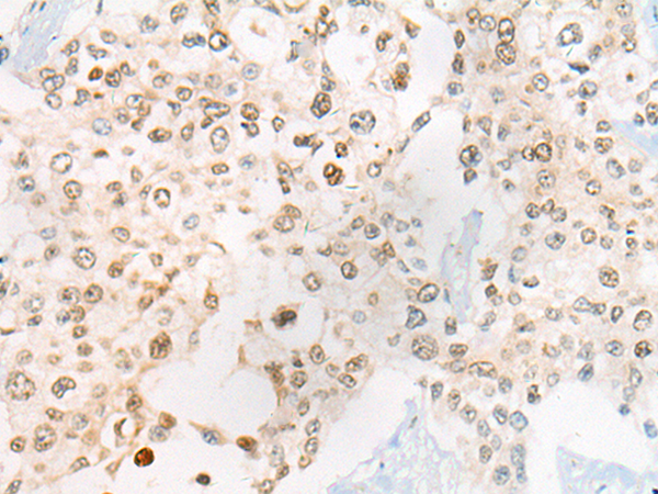 Immunohistochemistry of paraffin-embedded Human prost ate cancer tissue  using CEP72 Polyclonal Antibody at dilution of 1:40(×200)