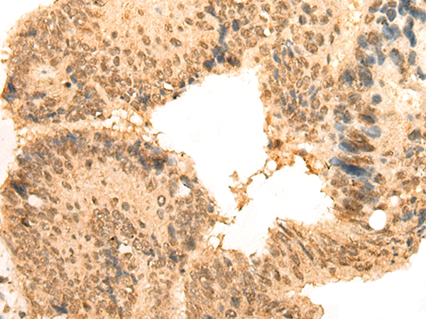 Immunohistochemistry of paraffin-embedded Human colorectal cancer tissue  using CEP57 Polyclonal Antibody at dilution of 1:30(×200)