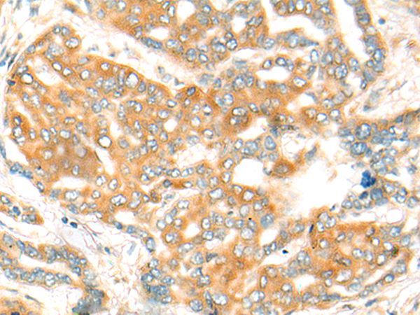 Immunohistochemistry of paraffin-embedded Human liver cancer tissue  using CFHR2 Polyclonal Antibody at dilution of 1:35(×200)