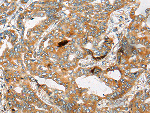 Immunohistochemistry of paraffin-embedded Human liver cancer tissue  using CHCHD3 Polyclonal Antibody at dilution of 1:25(×200)