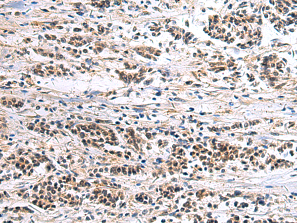 Immunohistochemistry of paraffin-embedded Human breast cancer tissue  using CLCN7 Polyclonal Antibody at dilution of 1:105(×200)