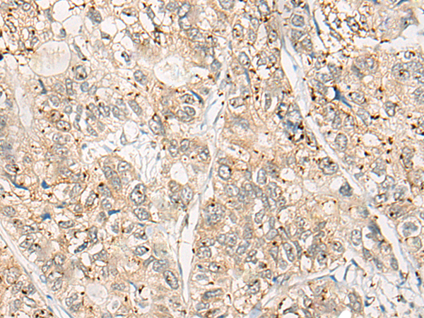 Immunohistochemistry of paraffin-embedded Human gastric cancer tissue  using CPNE4 Polyclonal Antibody at dilution of 1:40(×200)