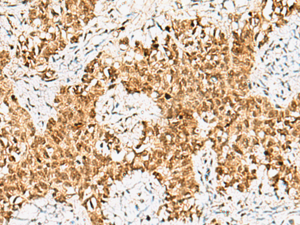 Immunohistochemistry of paraffin-embedded Human ovarian cancer tissue  using CRCP Polyclonal Antibody at dilution of 1:65(×200)