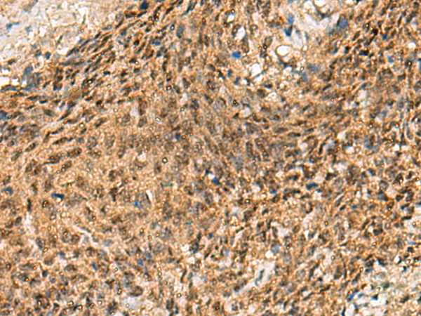Immunohistochemistry of paraffin-embedded Human cervical cancer tissue  using CRCP Polyclonal Antibody at dilution of 1:65(×200)