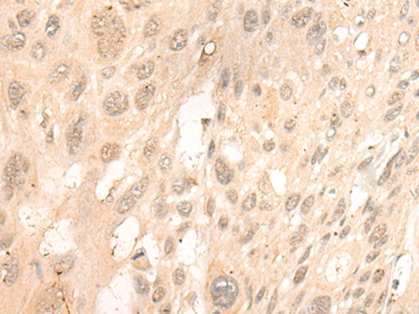 Immunohistochemistry of paraffin-embedded Human esophagus cancer tissue  using CUTA Polyclonal Antibody at dilution of 1:45(×200)