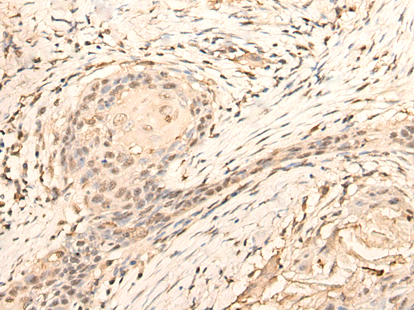 Immunohistochemistry of paraffin-embedded Human esophagus cancer tissue  using DAZ1 Polyclonal Antibody at dilution of 1:70(×200)