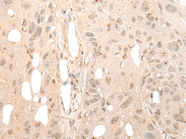 Immunohistochemistry of paraffin-embedded Human esophagus cancer tissue  using DDX21 Polyclonal Antibody at dilution of 1:40(×200)
