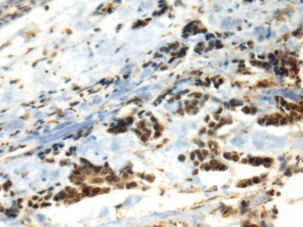 Immunohistochemistry of paraffin-embedded Human breast cancer tissue  using DDX39A Polyclonal Antibody at dilution of 1:70(×200)