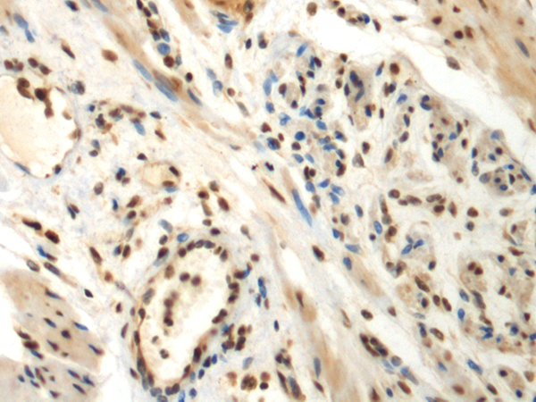 Immunohistochemistry of paraffin-embedded Human thyroid cancer tissue  using DDX39A Polyclonal Antibody at dilution of 1:70(×200)