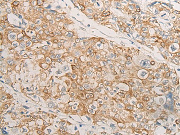 Immunohistochemistry of paraffin-embedded Human prost at e cancer tissue  using HLA-DMB Polyclonal Antibody at dilution of 1:40(×200)