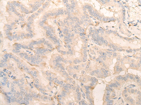 Immunohistochemistry of paraffin-embedded Human thyroid cancer tissue  using PITPNB Polyclonal Antibody at dilution of 1:25(×200)