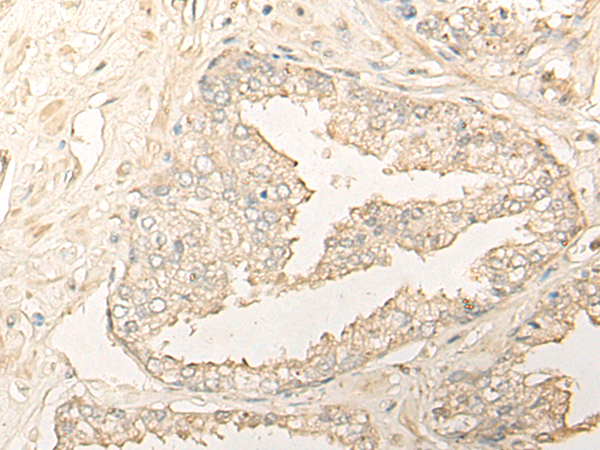 Immunohistochemistry of paraffin-embedded Human prost at e cancer tissue  using DIMT1 Polyclonal Antibody at dilution of 1:35(×200)