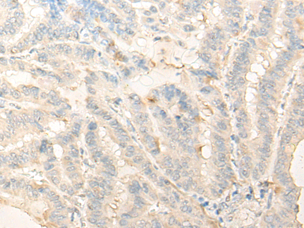 Immunohistochemistry of paraffin-embedded Human thyroid cancer tissue  using DIMT1 Polyclonal Antibody at dilution of 1:35(×200)