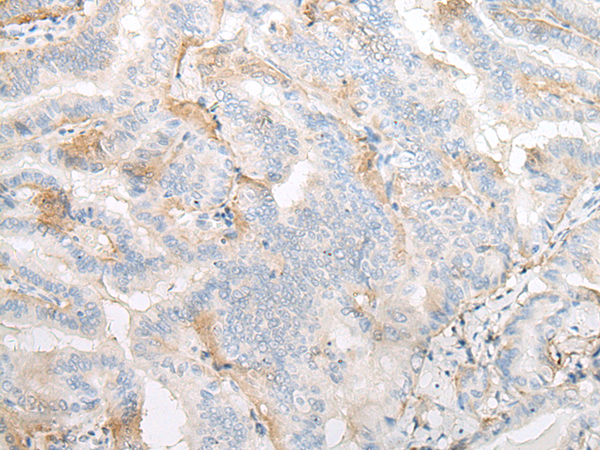 Immunohistochemistry of paraffin-embedded Human thyroid cancer tissue  using TMEM248 Polyclonal Antibody at dilution of 1:25(×200)