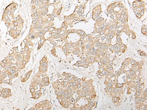 Immunohistochemistry of paraffin-embedded Human liver cancer tissue  using DHRS7 Polyclonal Antibody at dilution of 1:30(×200)